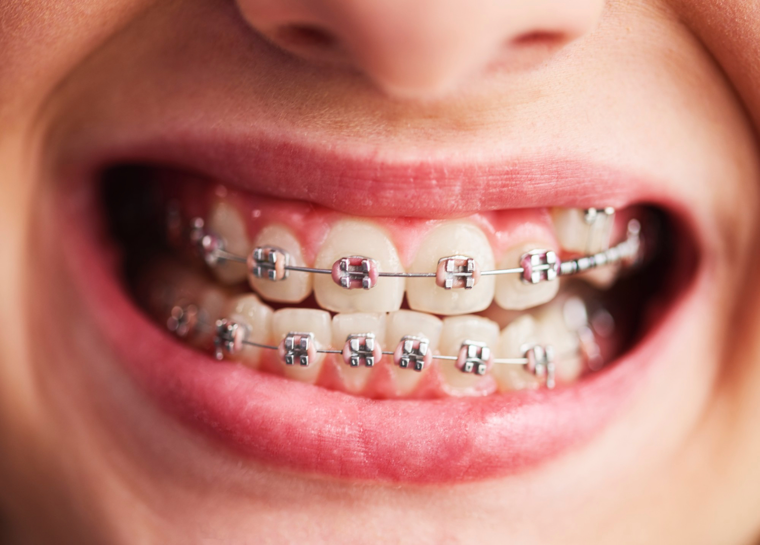 Traditional Braces at The tooth Place, Bolton Dentist