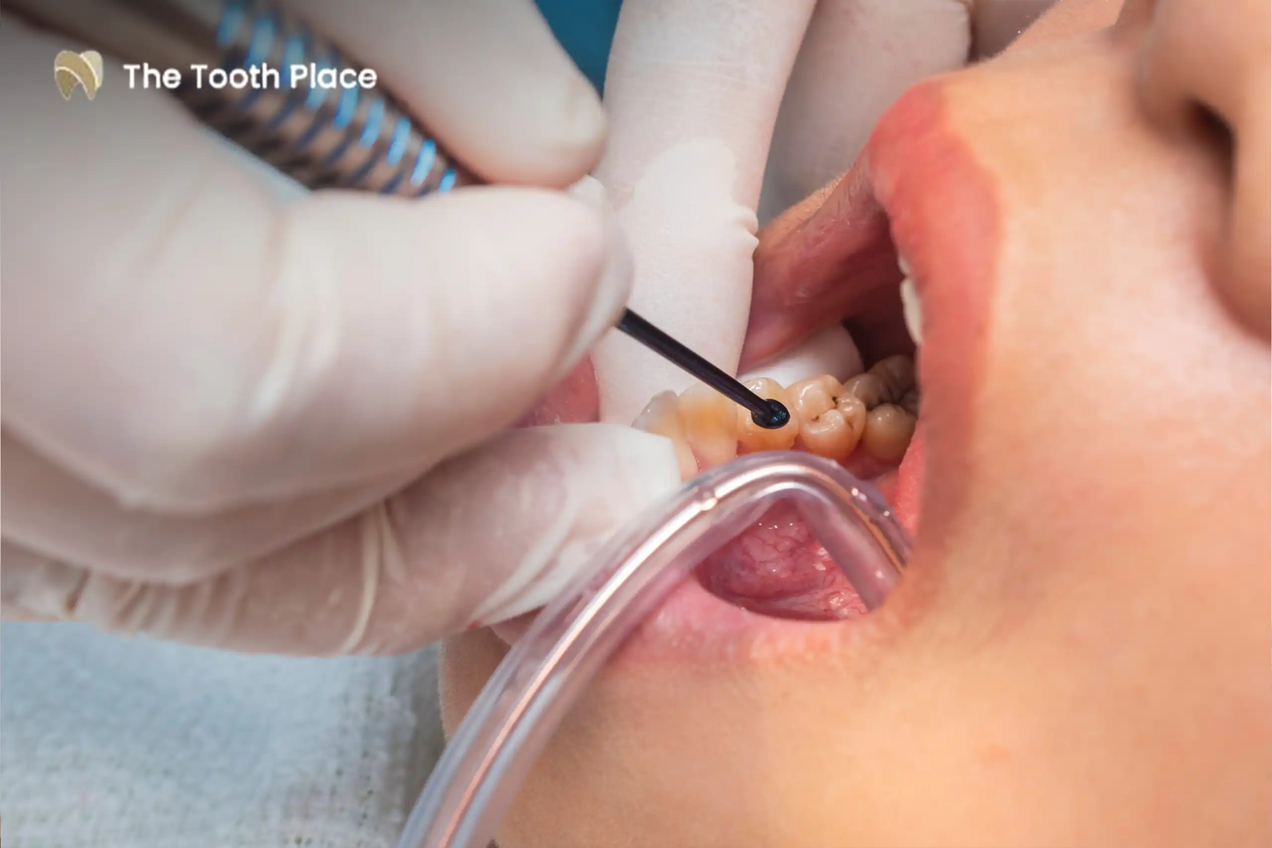 Icon Treatment How to Fix White Spots and Early Cavities Without Drilling