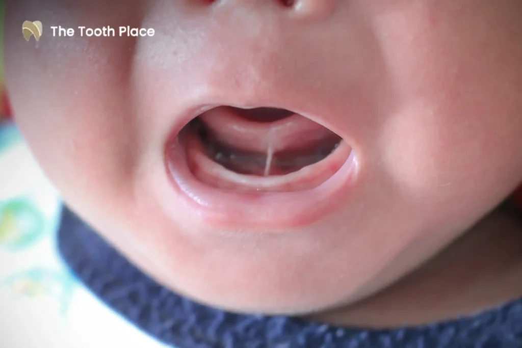 Tongue-Tie and Lip Tie Signs Treatment and When a Frenectomy Is Needed