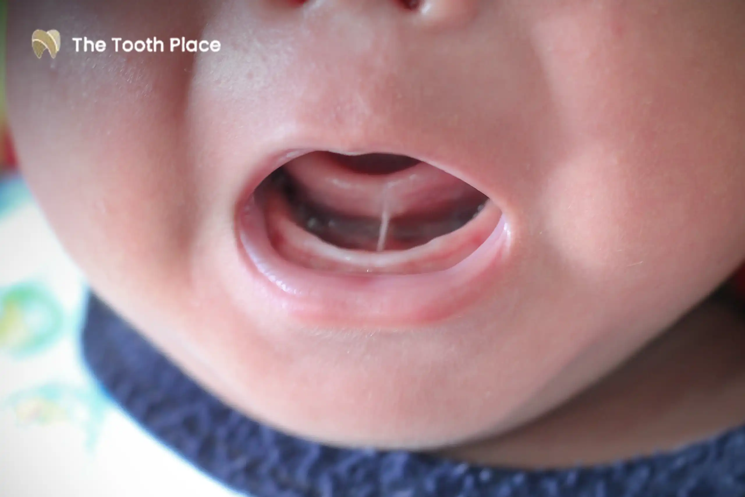 Tongue-Tie and Lip Tie Signs Treatment and When a Frenectomy Is Needed